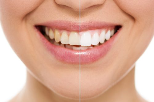 clareamento-dental-personalizado-odonto-special
